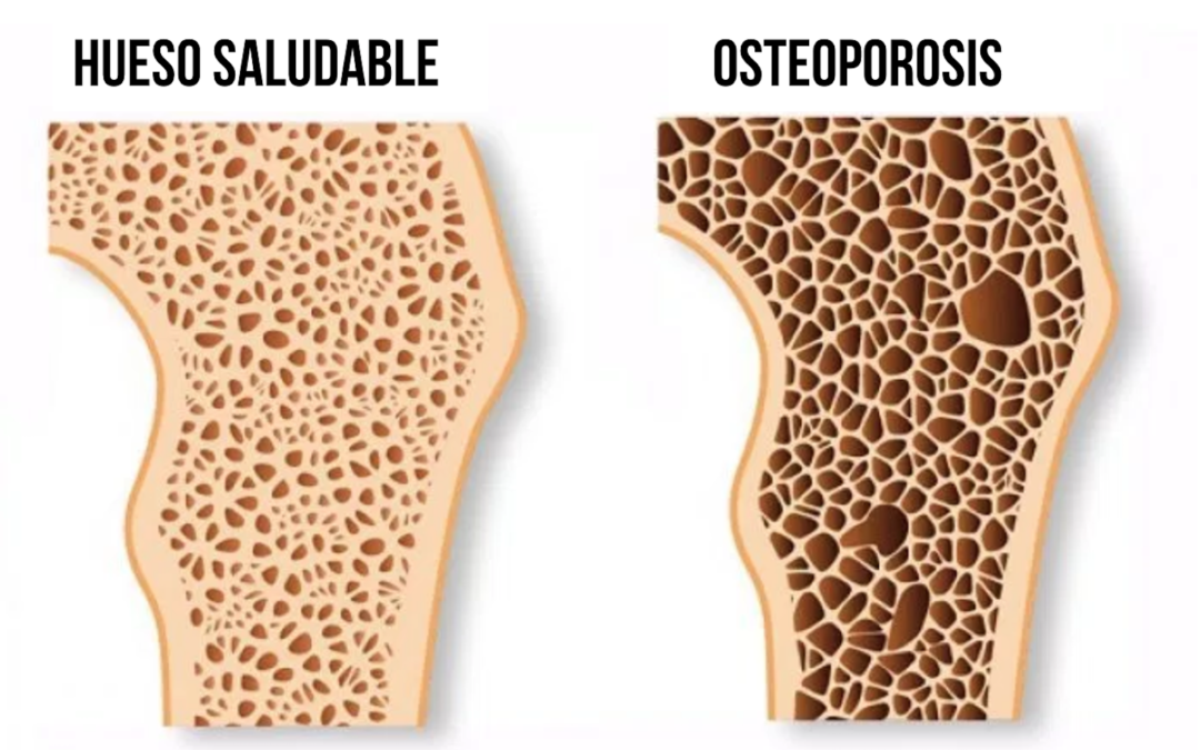 Tips contra la Osteoporosis